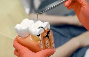 ROOT CANAL TREATMENT