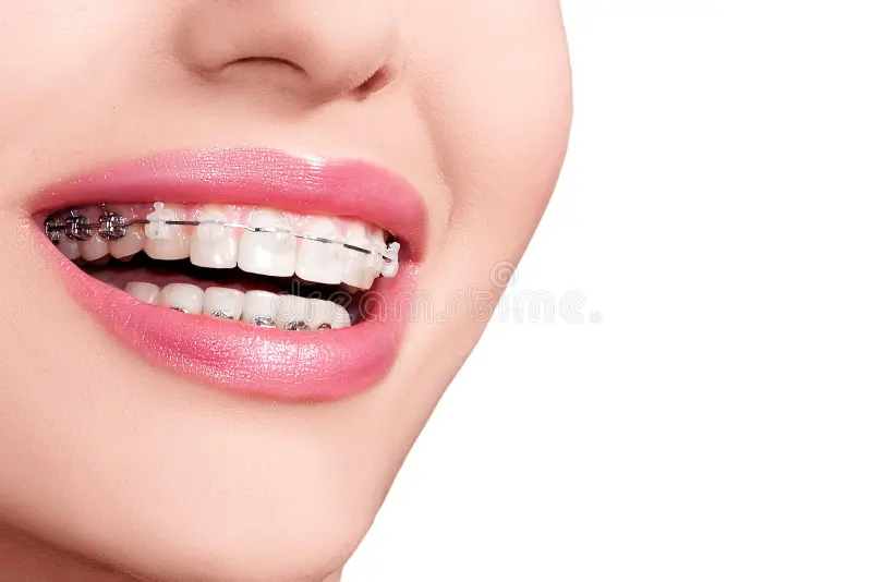 braces