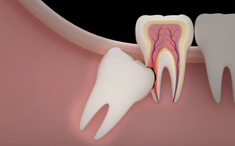 wisdom tooth