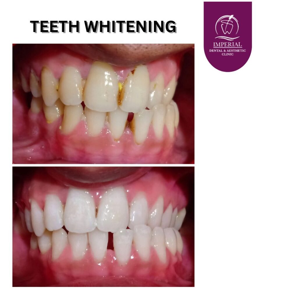 Teeth Whitening