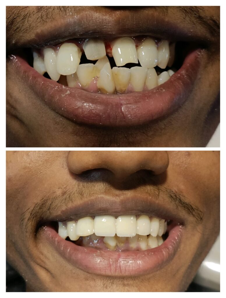 Smile Correction