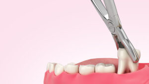Dental Extractions & Impactions