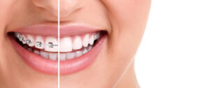 Best Orthodontic Treatment (Braces Treatment)