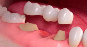fixed partial denture