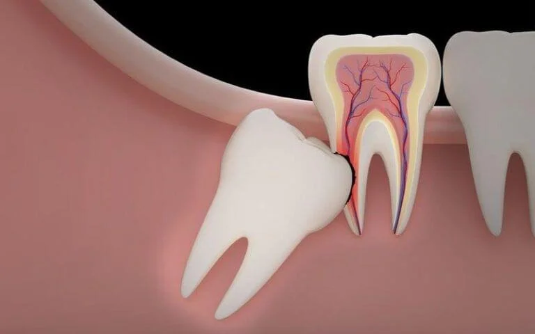 wisdom tooth