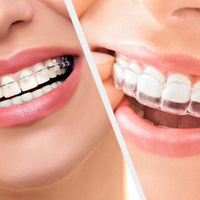 Braces Treatment